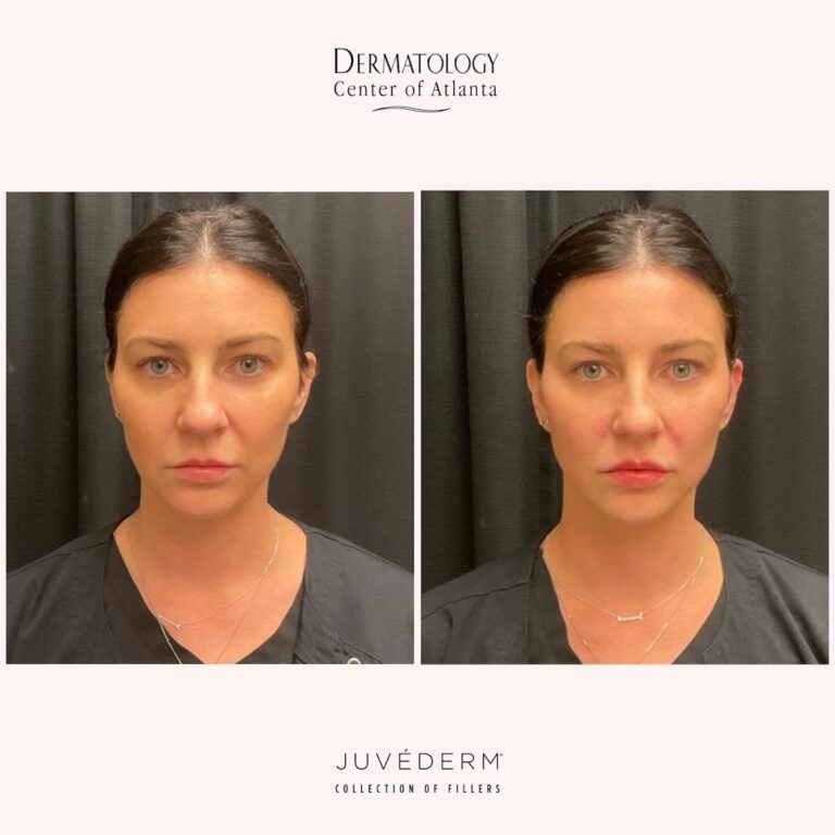 DCA Juvederm Volux Front View Amber