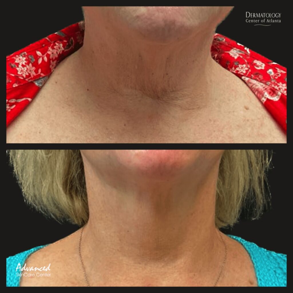 Before After 3 vivace treatments to neck
