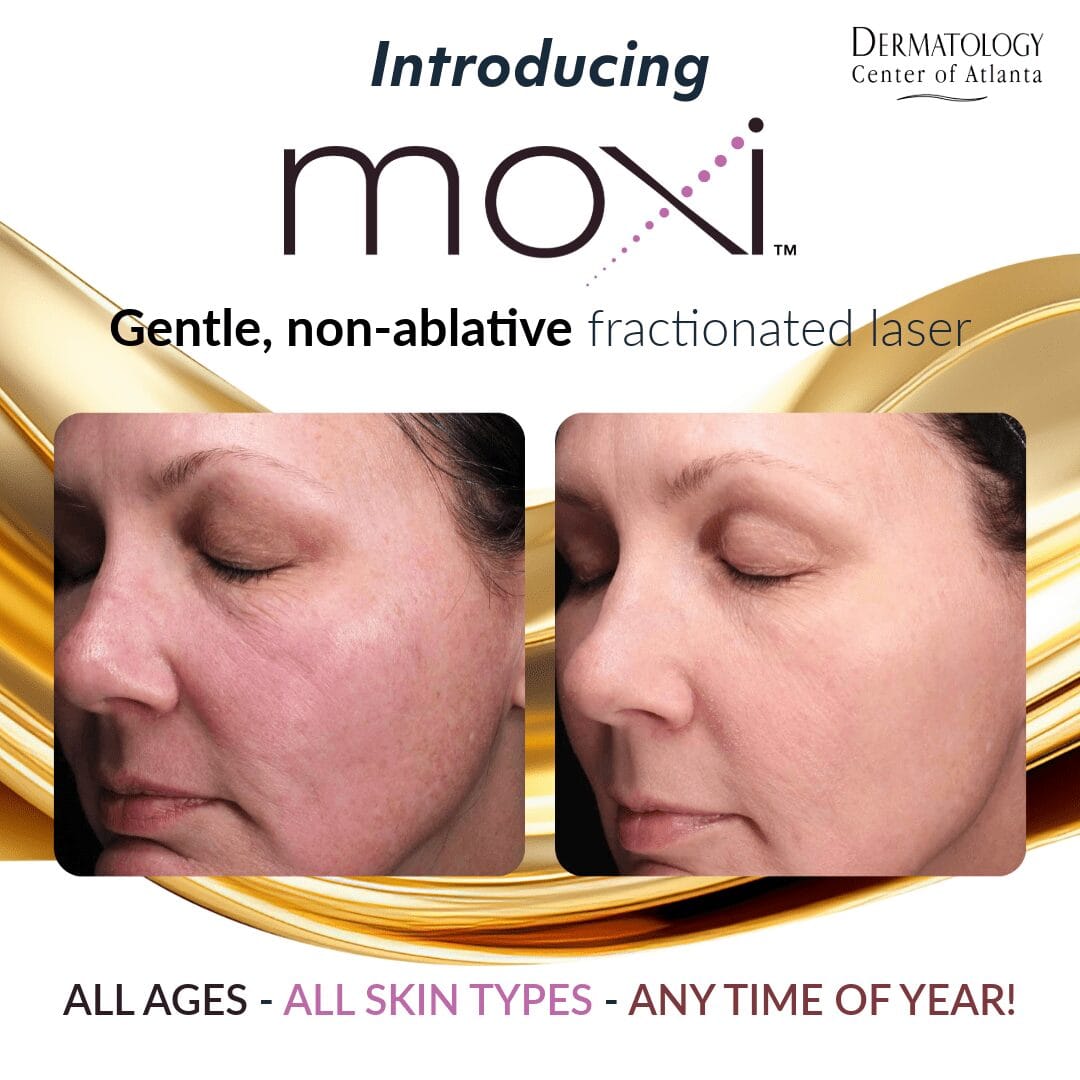Introducing Moxi Laser Treatment at Derm Center of Atlanta