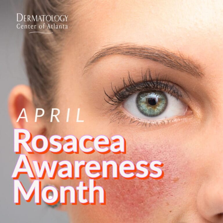 Rosacea Awareness Month Procedures available at DCA